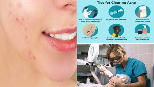 Medical Treatments for Acne